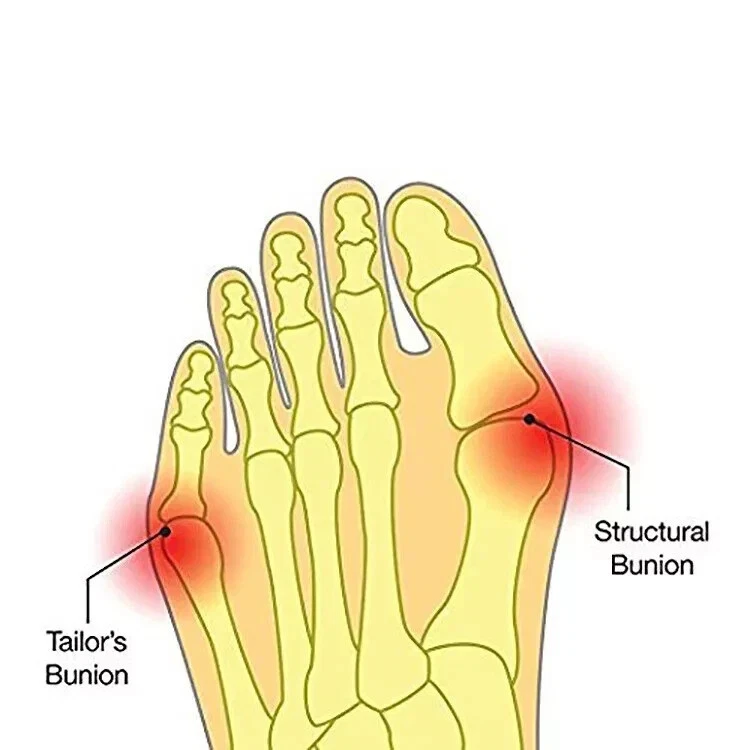 Bunion Corrector Sleeve – Best Selling Product in UK - Image 3