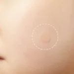 48PCS Skin Tag & Acne Patch – hydrocolloid acne patches UK for Acne, Pimples & Scar Healing - Image 3